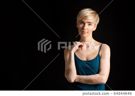 Woman in black top showing white vitiligo spots 64844646