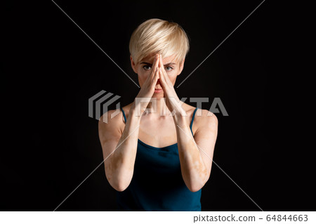 Psychological complexes due illness. Woman with problem skin 64844663