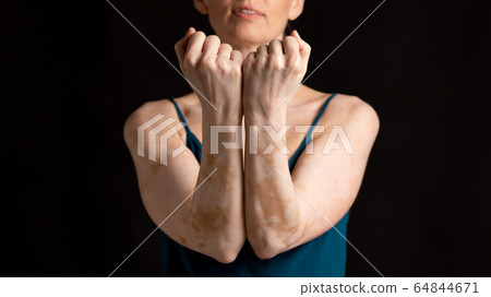 Girl in studio with vitiligo disease and skin trouble 64844671