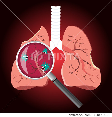 Damaged from Coronavirus cells with magnifying glass inspecting the affected on lung. COVID-19 with scary and evil face eating lung. 2019-nCoV concept. 64871586