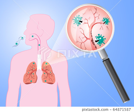Damaged from Coronavirus cells with magnifying glass inspecting the affected on lung. COVID-19 with scary and evil face eating lung. 2019-nCoV concept. Damaged from Coronavirus cells with magnifying glass inspecting the affected on lung. COVID-19 with scary and evil face eating lung. 2019-nCoV concept. 64871587