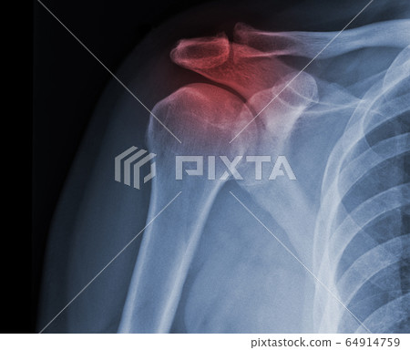 X-ray shoulder radiograph show state of injury 64914759