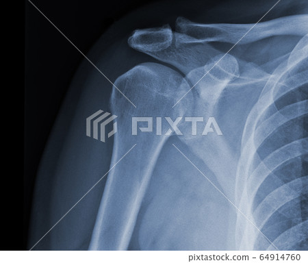 X-ray shoulder radiograph show state of injury 64914760