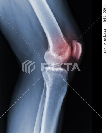 X-ray knee radiograph show state of injury X-ray knee radiograph show state of injury 64920803