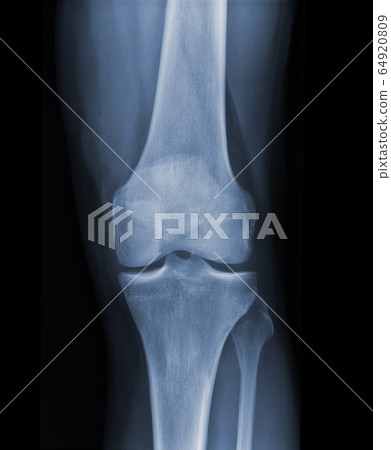 X-ray knee radiograph show state of injury 64920809