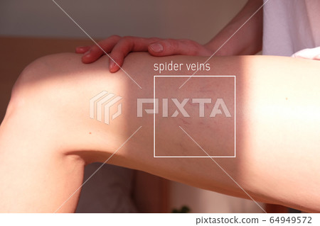 The thigh of the affected varicose veins The thigh of the affected varicose veins 64949572