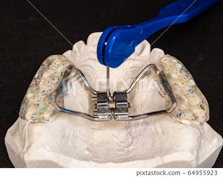 Setting of braces with expansion screw on teeth 64955923