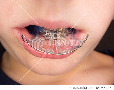 Blue dental braces in chuldren mouth. Blue dental braces in chuldren mouth. 64955927