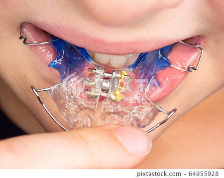 View of child jaw with braces installed to tooth. View of child jaw with braces installed to tooth. 64955928