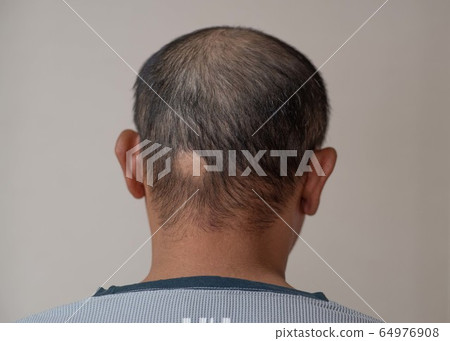 Circular hair loss 64976908