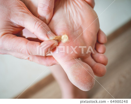 Close up photo of plantar wart on man's foot. Verruca plantaris on the heel is sealed with a salicylic plaster. Close up photo of plantar wart on man's foot. Verruca plantaris on the heel is sealed with a salicylic plaster. 64980248