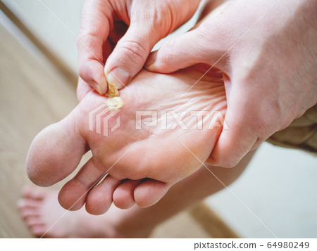 Close up photo of plantar wart on man's foot. Verruca plantaris on the heel is sealed with a salicylic plaster. 64980249