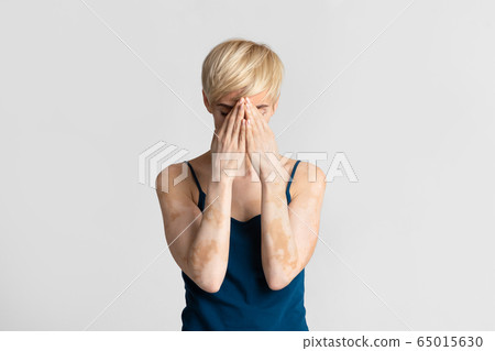 Woman with violation of skin pigmentation, tired of hiding Woman with violation of skin pigmentation, tired of hiding 65015630