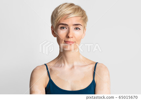 Portrait of woman with autoimmune disease vitiligo Portrait of woman with autoimmune disease vitiligo 65015670