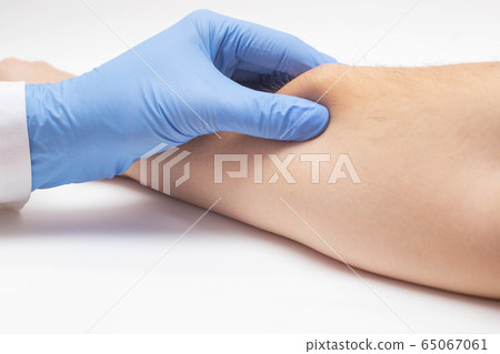Doctor dermatologist examines the subcutaneous wen on the patient's arm, close-up. Skin cancer, malignancy disease concept Doctor dermatologist examines the subcutaneous wen on the patient's arm, close-up. Skin cancer, malignancy disease concept 65067061