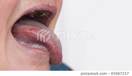 Woman with a disease and redness of the tongue. Glossitis and gingivitis disease concept, copy space 65067257
