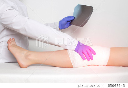 An orthopedic doctor holds an x-ray picture of a patient's knee. The concept of diseases and injuries of the knee and patella, sprain 65067643