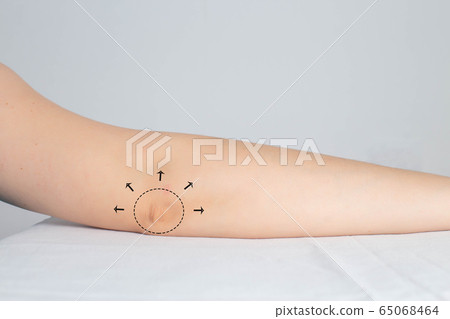 Markers on the elbow in humans for plastic surgery on the elbow. Wrinkle and Skin Tightening, brachioplasty 65068464