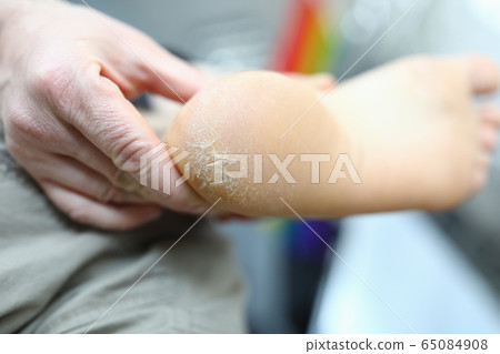 Dermatology problem and dryness Dermatology problem and dryness 65084908