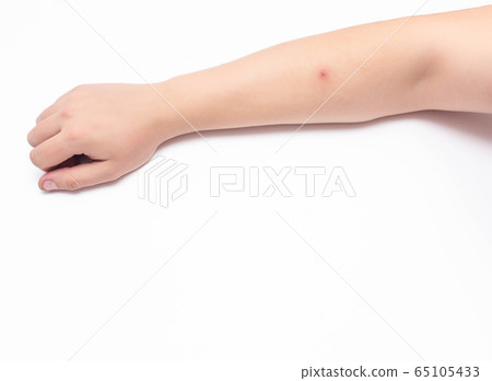 Red sore pimple on a person's hand, white background, close-up, copy space, inflammation 65105433