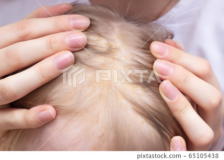 Seborrheic skin rash on the child s head, seborrheic dermatitis, close-up, healthcare, medicine Seborrheic skin rash on the child s head, seborrheic dermatitis, close-up, healthcare, medicine 65105438
