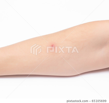 Red inflamed furuncle on a person s arm, infection, white background, close-up, pustule 65105699