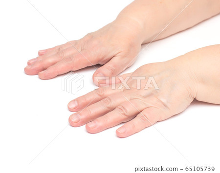 The hands of an elderly woman on a white background which has skin problems, irritation and redness on the skin, hypoallergenic, isolat, moisturizing The hands of an elderly woman on a white background which has skin problems, irritation and redness on the skin, hypoallergenic, isolat, moisturizing 65105739