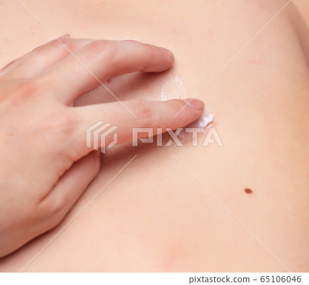 A girl smears a scar on her body with a healing cream to heal scars and scars, close-up, copy space 65106046