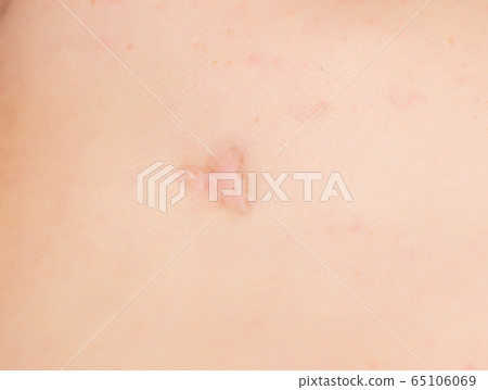 Large scar and scar on the patient's skin after removing an inflamed pimple, close-up, professional Large scar and scar on the patient's skin after removing an inflamed pimple, close-up, professional 65106069