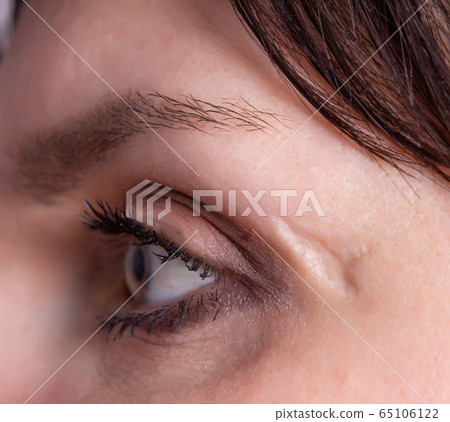 deep scar and scar on the face of the girl near the eye, close-up, skin problem, cosmetology 65106122