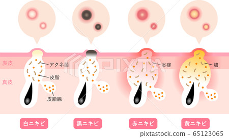 Acne Symptoms Skin Cross Section 65123065