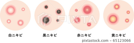 痤瘡症狀皮膚 痤瘡症狀皮膚 65123066