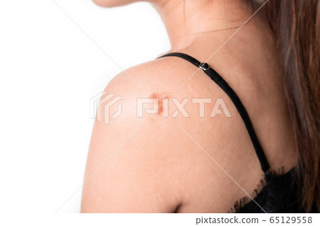 Asian women have keloid scar on shoulder on white 65129558