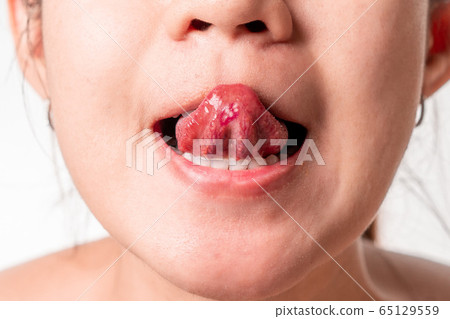 Asian women have aphthous ulcers on tongue on 65129559