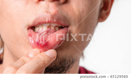 Asian man have aphthous ulcers on mouth on white 65129560