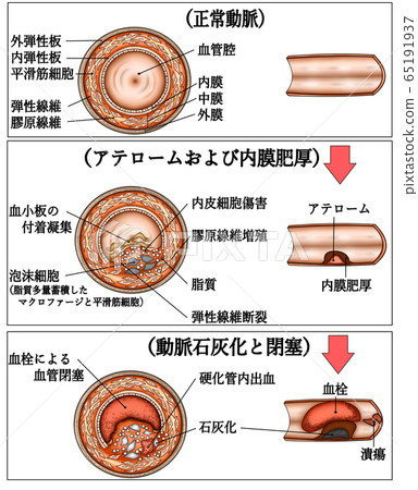 與動脈硬化插圖字母 插圖素材 圖庫