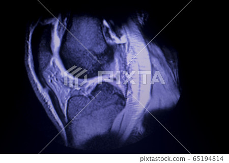 MRI knee meniscus tear scan 65194814