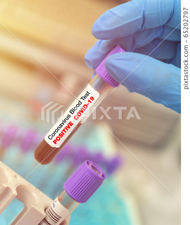 Tubes of blood sample for Coronavirus COVID-19 Tubes of blood sample for Coronavirus COVID-19 65202797