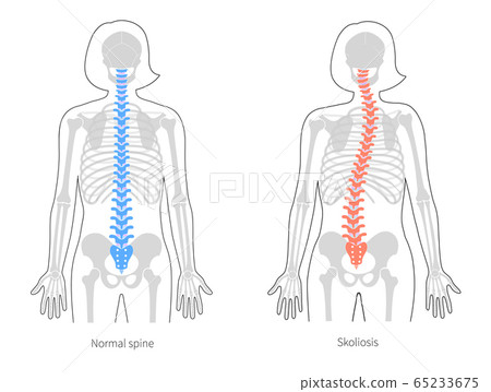 Scoliosis flat vector illustration 65233675