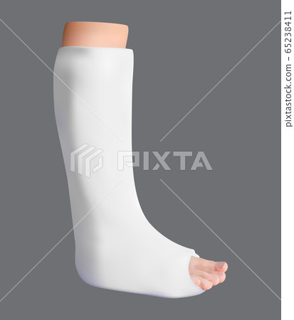 Plastered leg. Treatment of a broken leg. Medicine and health. Isolated object. Vector 65238411