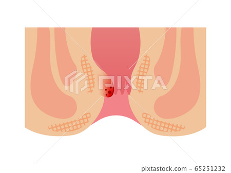 Hemorrhoid types / types (cutaway view of the... - Stock Illustration(No.65251232). Find images exactly you are looking for from more than 84,100,000 of royalty-free stock photos, illustrations, and vectors. Download and enjoy fresh & incredible images added every day.