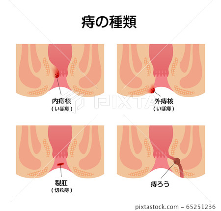 Hemorrhoid types / types (anal sectional view... - Stock Illustration(No.65251236). Find images exactly you are looking for from more than 84,100,000 of royalty-free stock photos, illustrations, and vectors. Download and enjoy fresh & incredible images added every day.