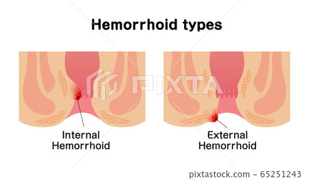 痔瘡類型/類型(肛門截面圖)/英文 痔瘡類型/類型(肛門截面圖)/英文 65251243