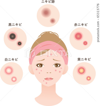 Acne women beauty 65313776