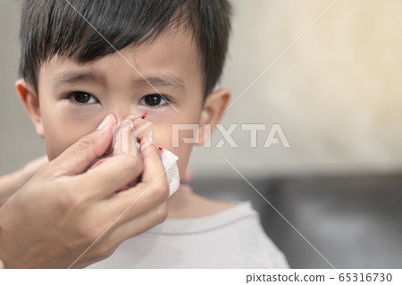 Portrait of cute Asian ethnic child having nosebleed,The concept of first aid for nosebleeds. Portrait of cute Asian ethnic child having nosebleed,The concept of first aid for nosebleeds. 65316730
