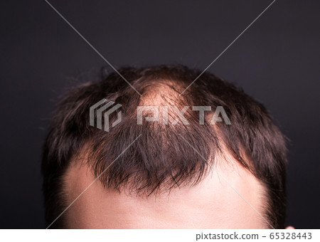 Male head close-up with baldness. Studio black background. 65328443