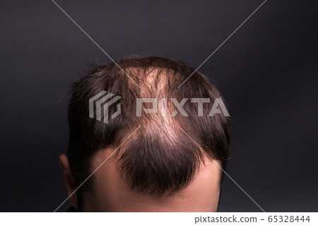 Male head close-up with baldness. Studio black background. 65328444