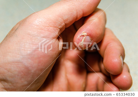 index finger dermatitis on male hand. 65334030