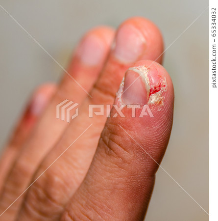 index finger dermatitis on male hand. 65334032
