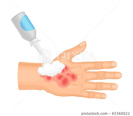 First Aid for Hand with Ambustion or Burn on the Skin Vector Illustration First Aid for Hand with Ambustion or Burn on the Skin Vector Illustration 65360022